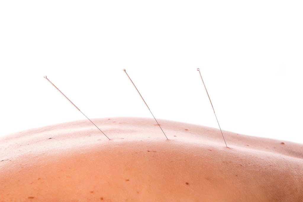 Vital Point Acupuncture | health | 126 Archer St, Woodford QLD 4514, Australia
