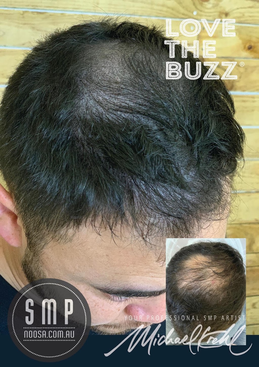 Scalp Micropigmentation Noosa, SMP Noosa | hair care | 39 Templeton Way, Doonan QLD 4562, Australia | 0468880767 OR +61 468 880 767