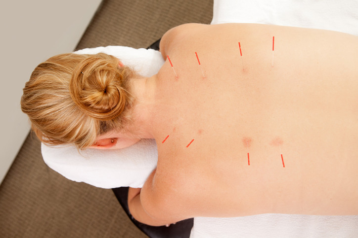 Mansfield Sports Acupuncture | 205 Piries-Goughs Bay Rd., (Piries), Mansfield VIC 3722, Australia | Phone: 0438 815 167