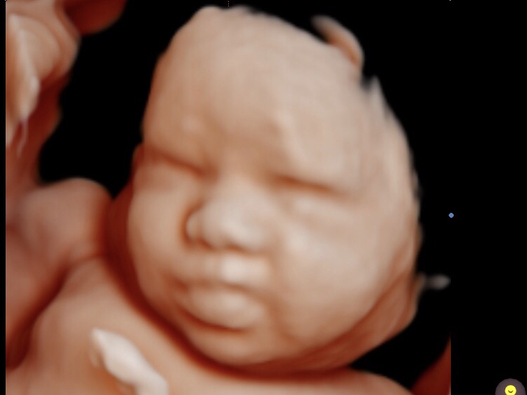 Bub-Scan 3D/4D Ultrasound | health | 5 Waldron Rd, Sefton NSW 2162, Australia | 0449938910 OR +61 449 938 910