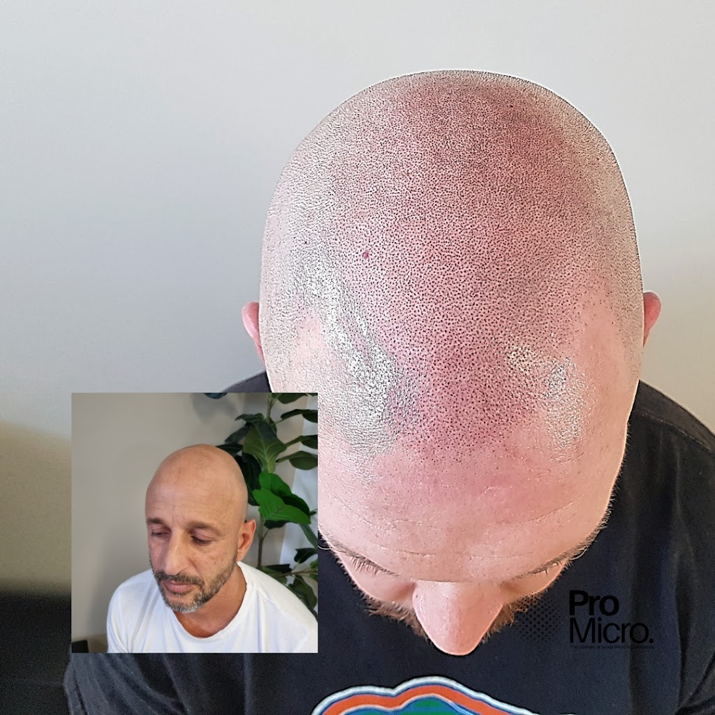 Pro Micro - Scalp Micropigmentation SMP | 23/58 Riverwalk Ave, Robina QLD 4226, Australia | Phone: 0437 778 852
