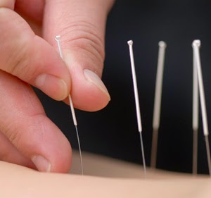 Chinese Acupuncture Clinic & Body Piercing | health | 99 Council Ave, Rockingham WA 6168, Australia | 0895922272 OR +61 8 9592 2272