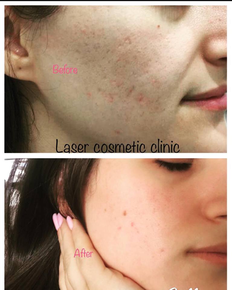 Laser cosmetic clinic | 16 St Marys St, West Hoxton NSW 2171, Australia | Phone: 0430 517 376