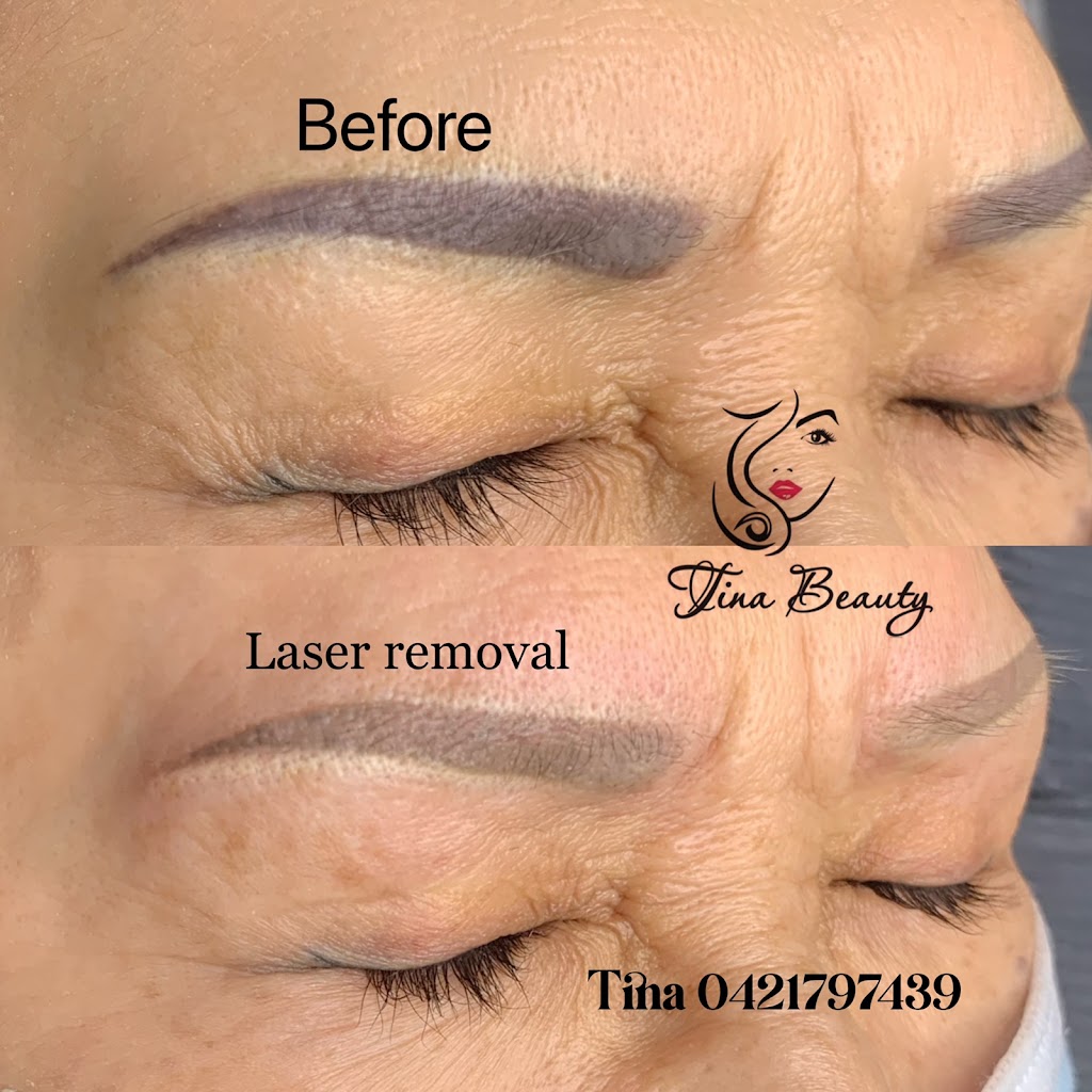 Melbourne Laser Eyebrows Tattoo Removal | 68 Spring Rd, Springvale South VIC 3172, Australia | Phone: 0403 816 410