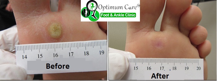 Optimum Care Foot & Ankle Clinic - Podiatrist Richmond | doctor | 6 Bridge Rd, Richmond VIC 3121, Australia | 0390775915 OR +61 3 9077 5915