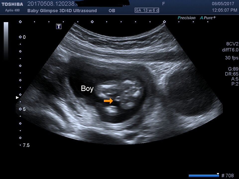 Baby Glimpse 3D/4D ultrasound | 2 Boronia Ave, Burwood NSW 2134, Australia | Phone: 0405 068 603