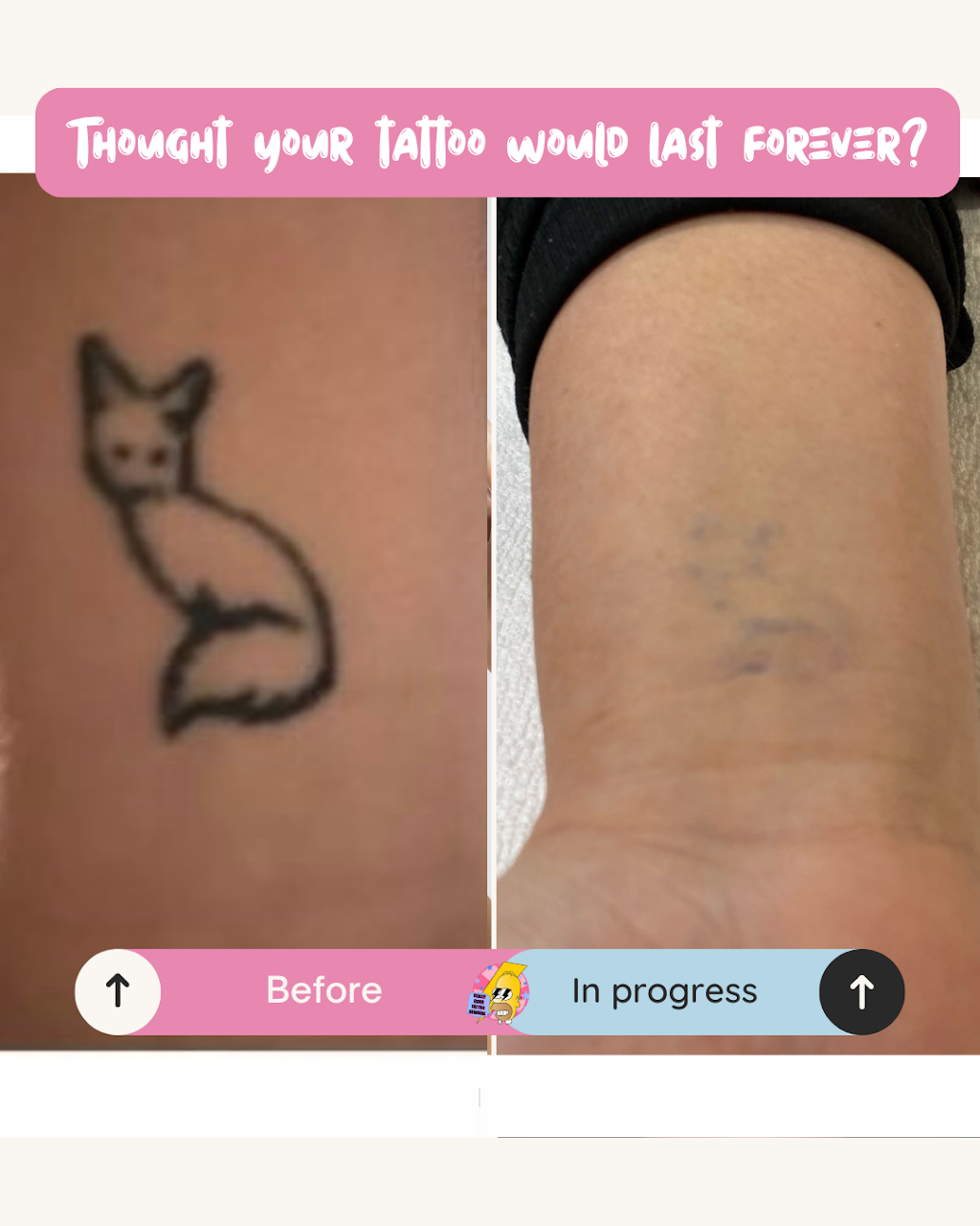 Really Good Tattoo Removal | 47 Clayton St, Sandgate QLD 4017, Australia | Phone: 0413 006 477