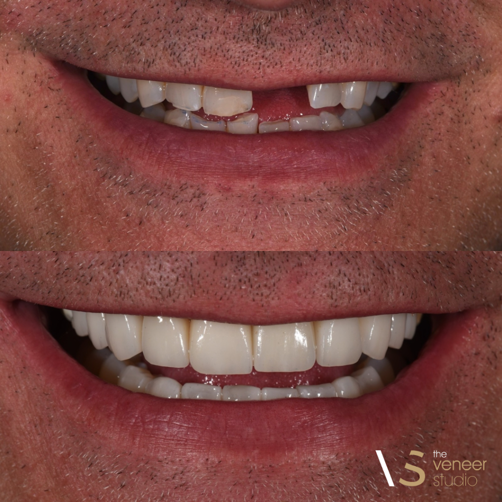The Veneer Studio | 130 Nepean Hwy, Aspendale VIC 3195, Australia | Phone: 1300 314 473
