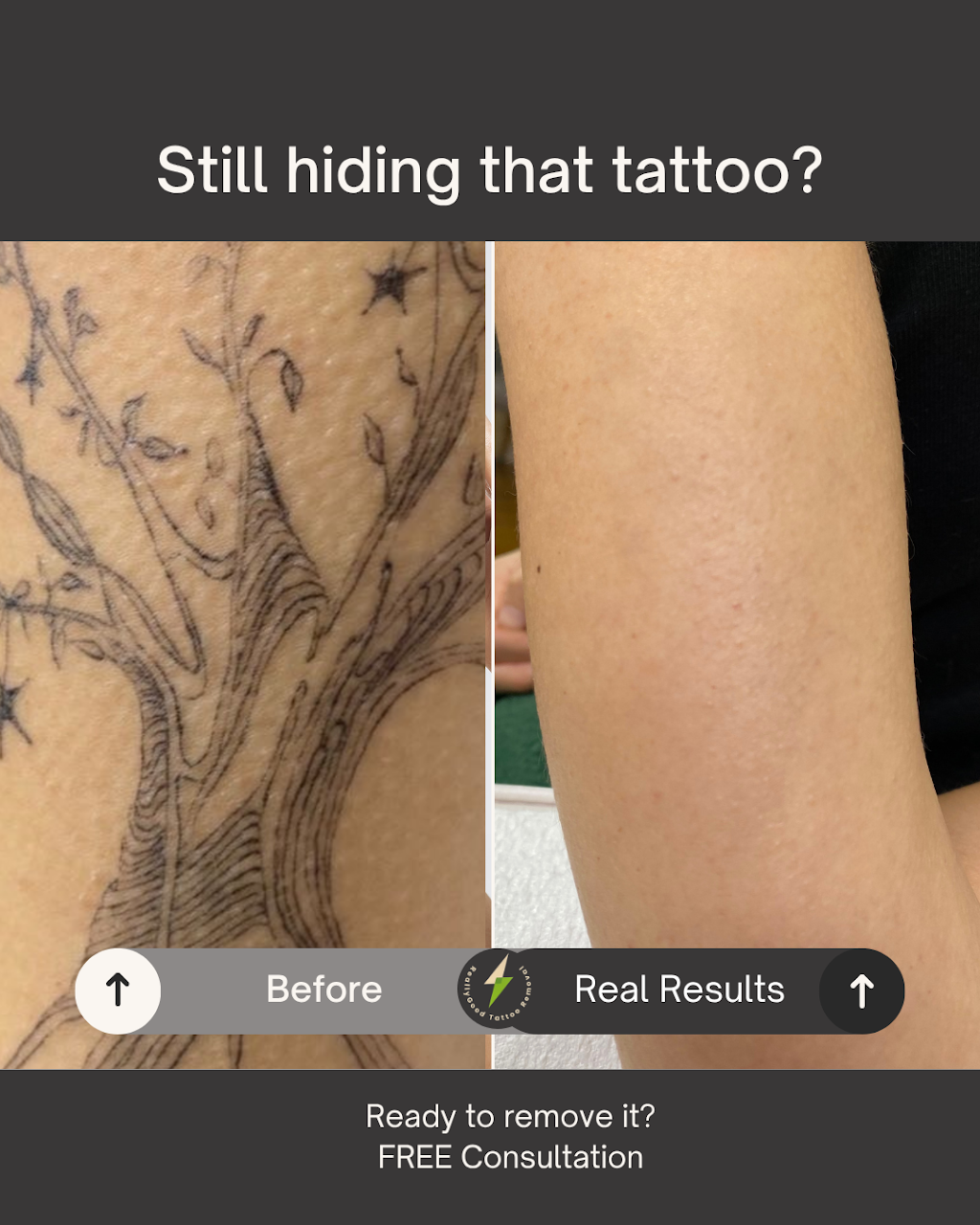 Really Good Tattoo Removal | 47 Clayton St, Sandgate QLD 4017, Australia | Phone: 0413 006 477