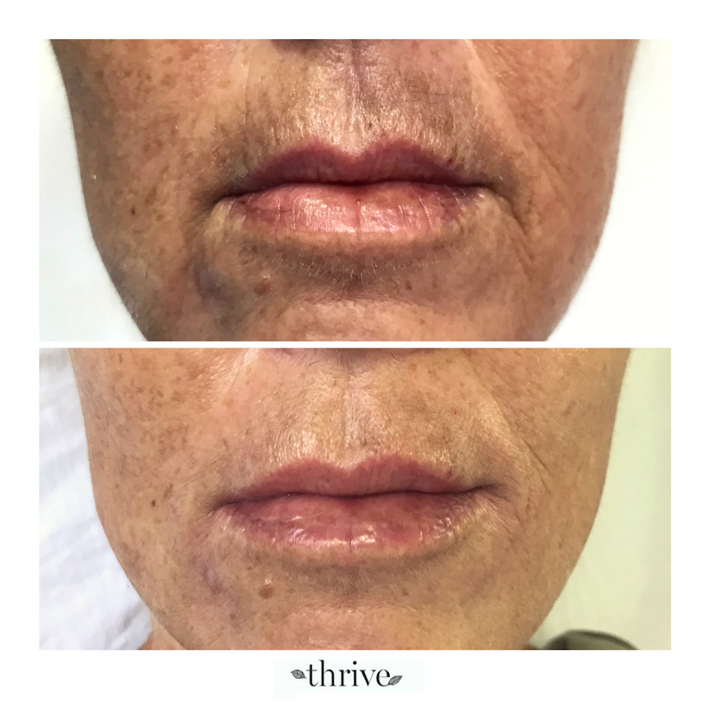 Thrive Skin Clinic | Shop 2/264- 270 Lawrence Hargrave Dr, Thirroul NSW 2515, Australia | Phone: 0404 123 781