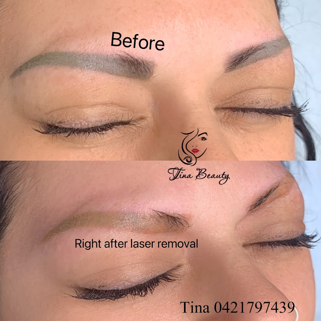 Melbourne Laser Eyebrows Tattoo Removal | 68 Spring Rd, Springvale South VIC 3172, Australia | Phone: 0403 816 410