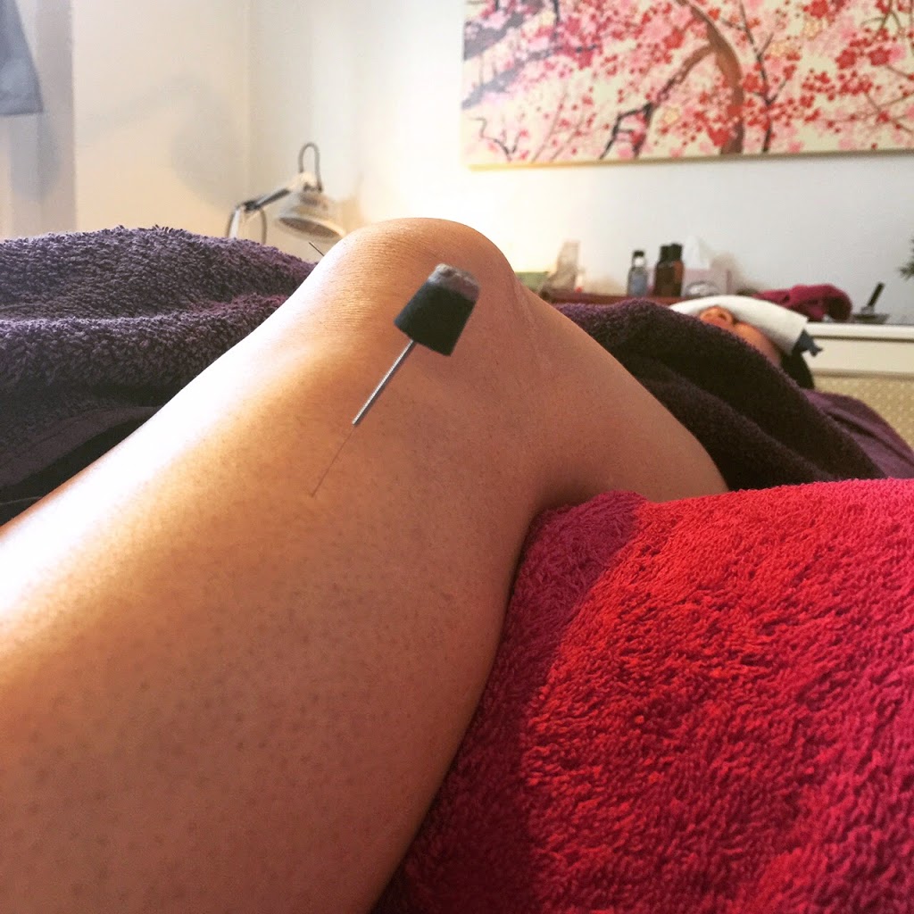 Fusion Acupuncture Brisbane | 455 S Pine Rd, Everton Park QLD 4053, Australia | Phone: 0448 844 551