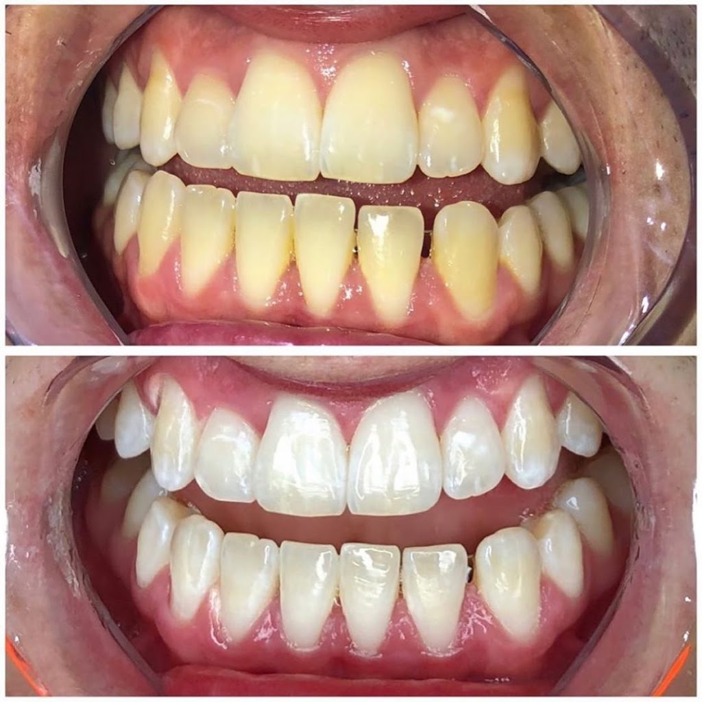 PureSmile Teeth Whitening Merrylands | dentist | 1/81-83 Merrylands Rd, Merrylands NSW 2160, Australia | 1300858199 OR +61 1300 858 199