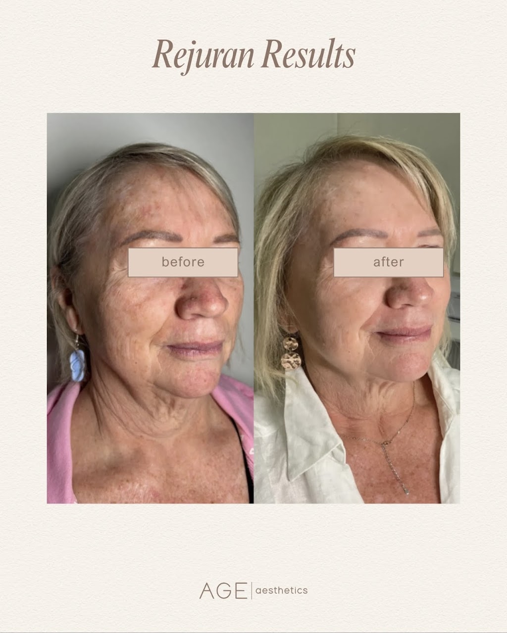 AGE aesthetics Torquay | 2C Gilbert St, Torquay VIC 3228, Australia | Phone: 0439 331 306