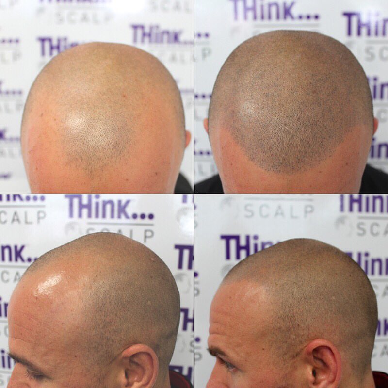 THink Scalp | hair care | The Gap Village, Suite 4/1000 Waterworks Rd, The Gap QLD 4061, Australia | 0733000465 OR +61 7 3300 0465