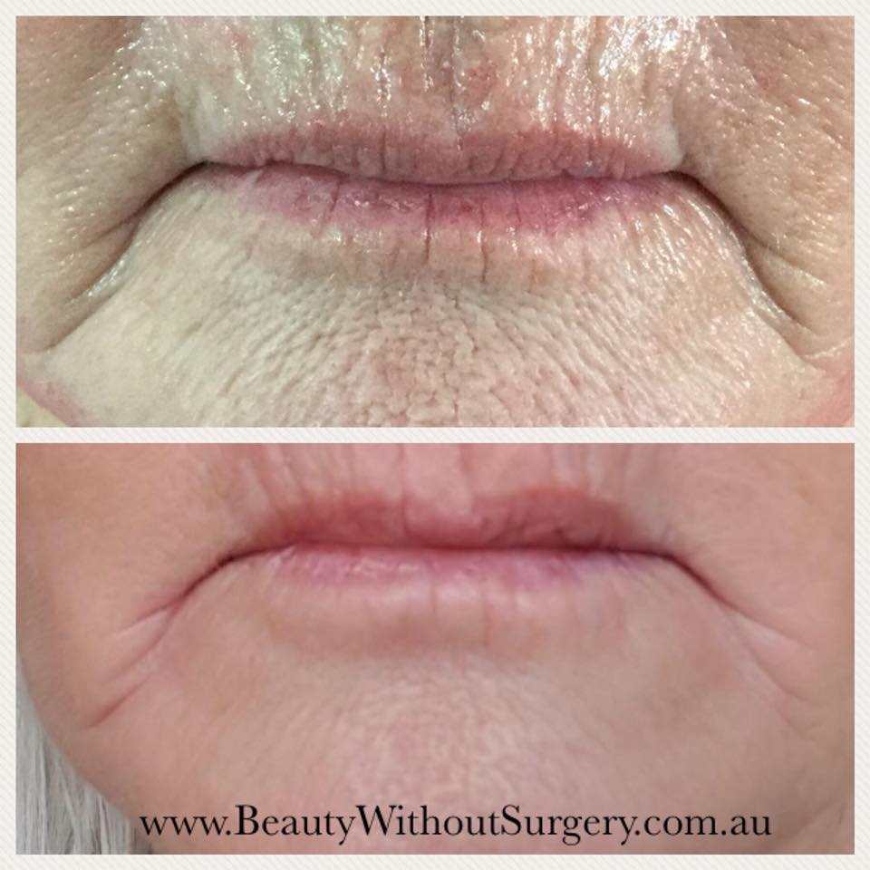 Beauty Without Surgery | store | 62 The Esplanade, Paradise Point QLD 4216, Australia | 0404838009 OR +61 404 838 009