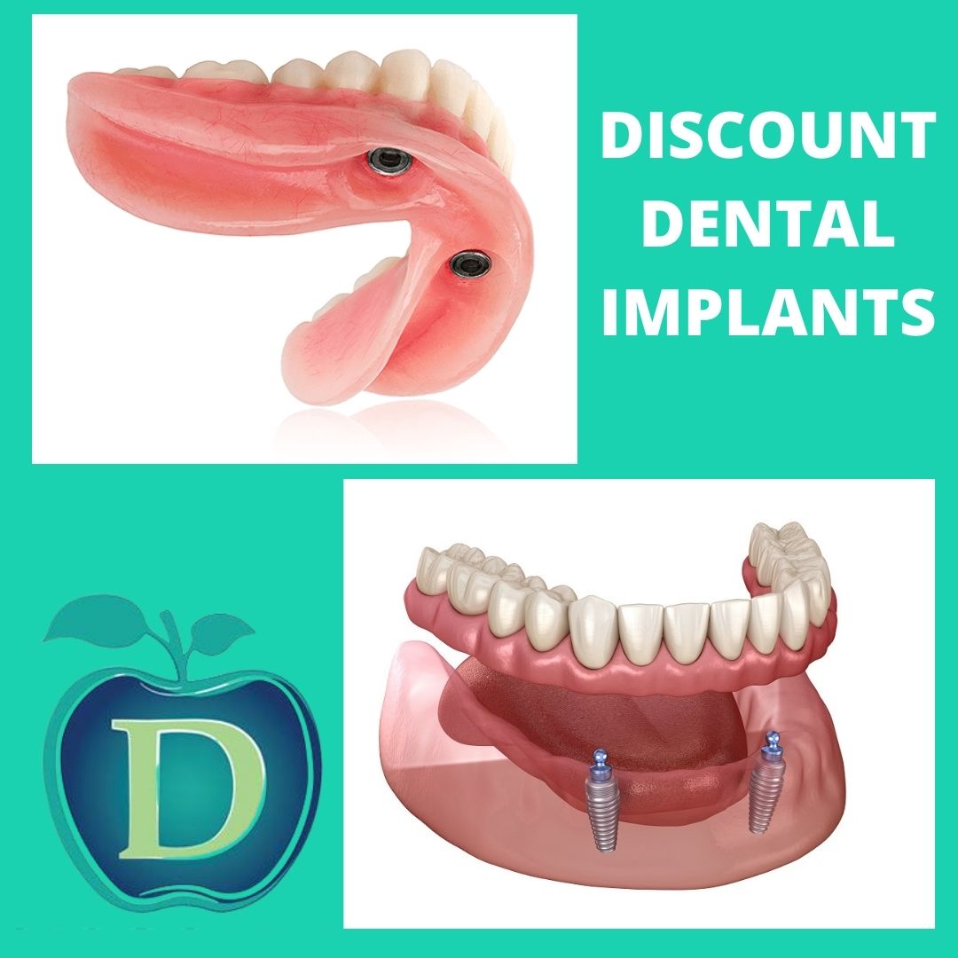 Discount Dentist & Dentures Joondalup | dentist | 5/42 Grand Blvd, Joondalup WA 6027, Australia | 0893002332 OR +61 8 9300 2332