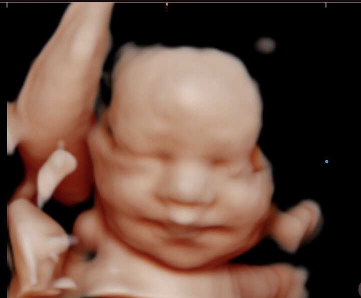 Bub-Scan 3D/4D Ultrasound | health | 5 Waldron Rd, Sefton NSW 2162, Australia | 0449938910 OR +61 449 938 910