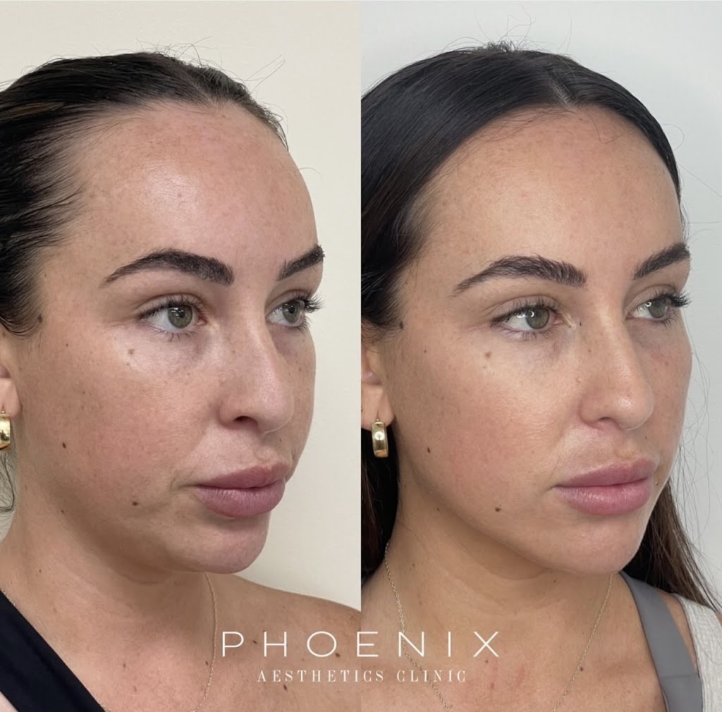 Phoenix Aesthetics Clinic | 30 Elizabeth Bay Dr, Lake Munmorah NSW 2259, Australia | Phone: 0448 784 066