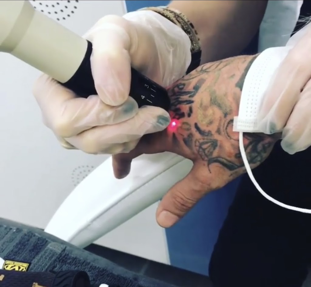 Eliminate Tattoo Removal | 408 Maitland Rd, Mayfield NSW 2304, Australia | Phone: 0403 700 146