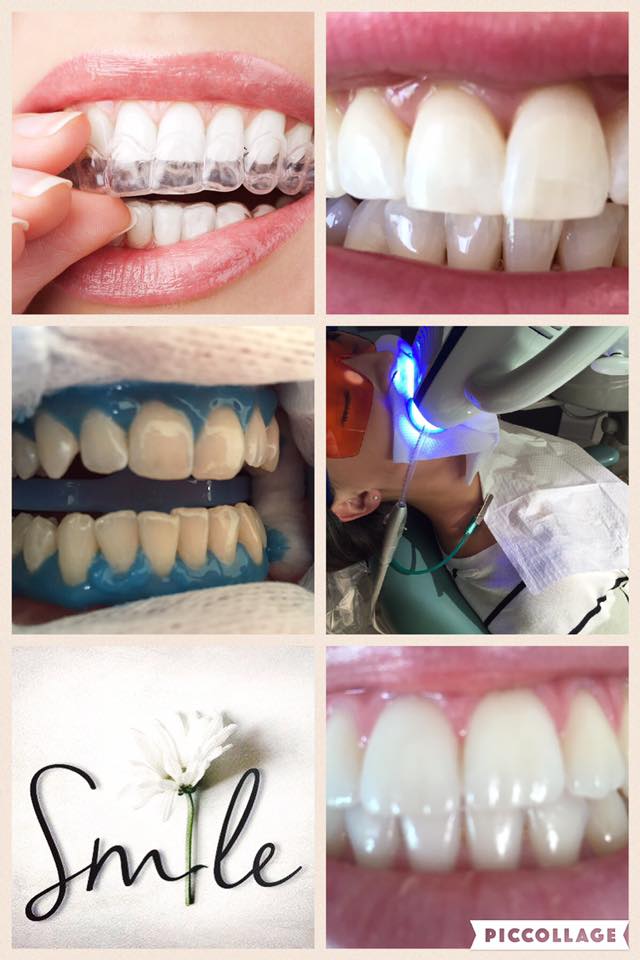 Pearly Whites Professional Teeth Whitening and Dental Hygiene | dentist | 37 Towerhill Rd, Somers VIC 3927, Australia | 0414331247 OR +61 414 331 247