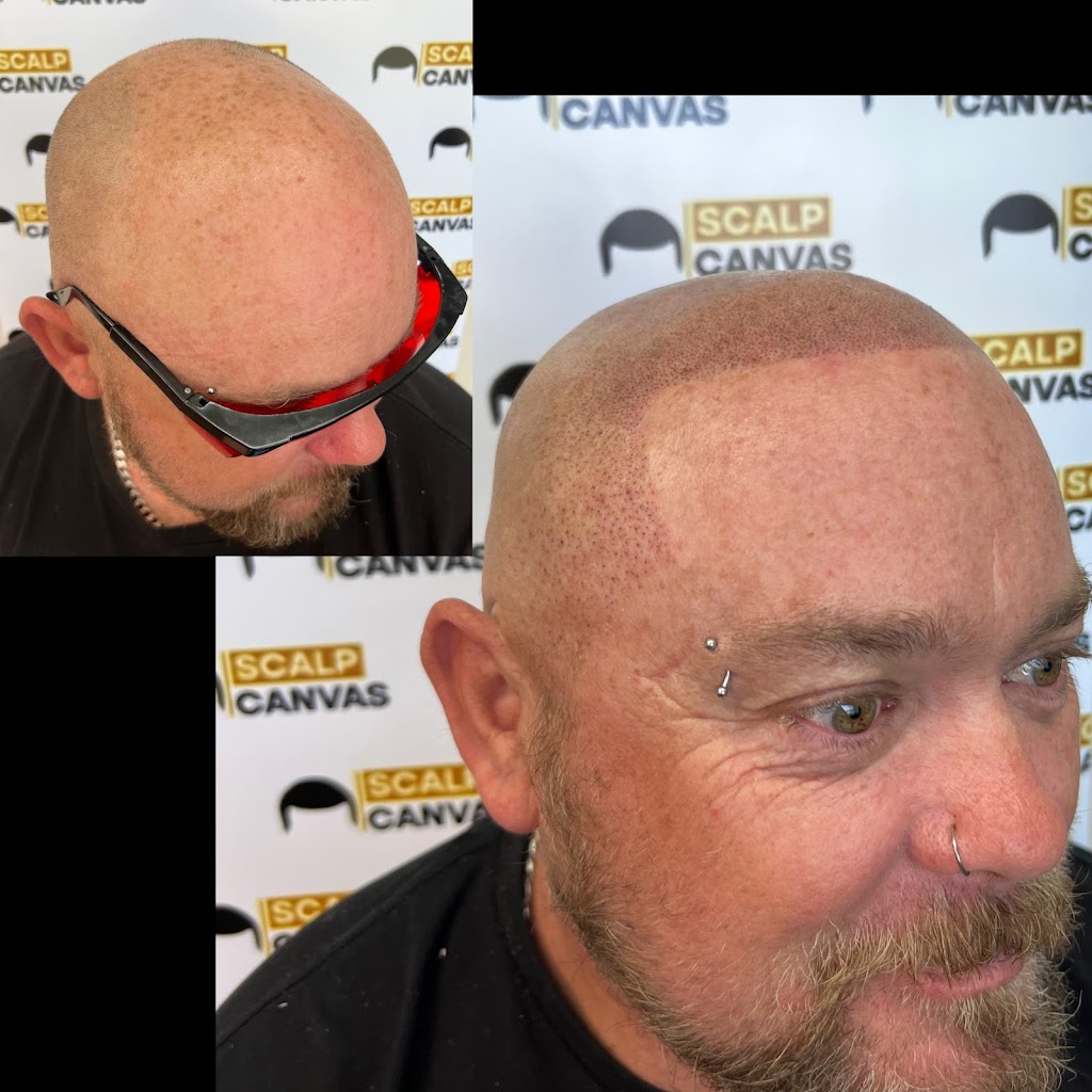 Scalp Canvas - Scalp Micropigmentation Sydney | 1 Inverness Cct, Cecil Hills NSW 2171, Australia | Phone: 0414 400 454