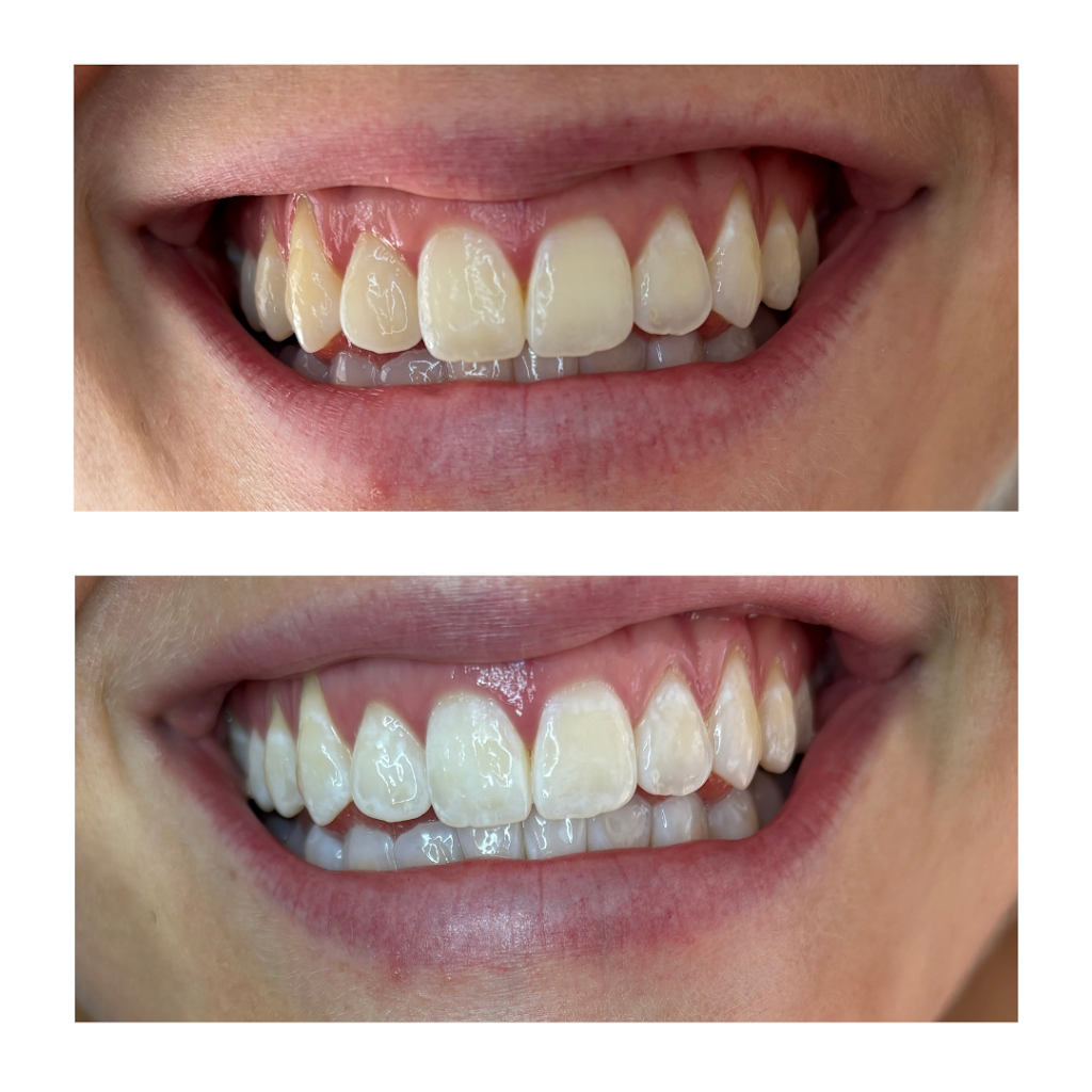 The Whitening Room | MacDougall Rd, Golden Gully VIC 3555, Australia | Phone: 0426 284 861