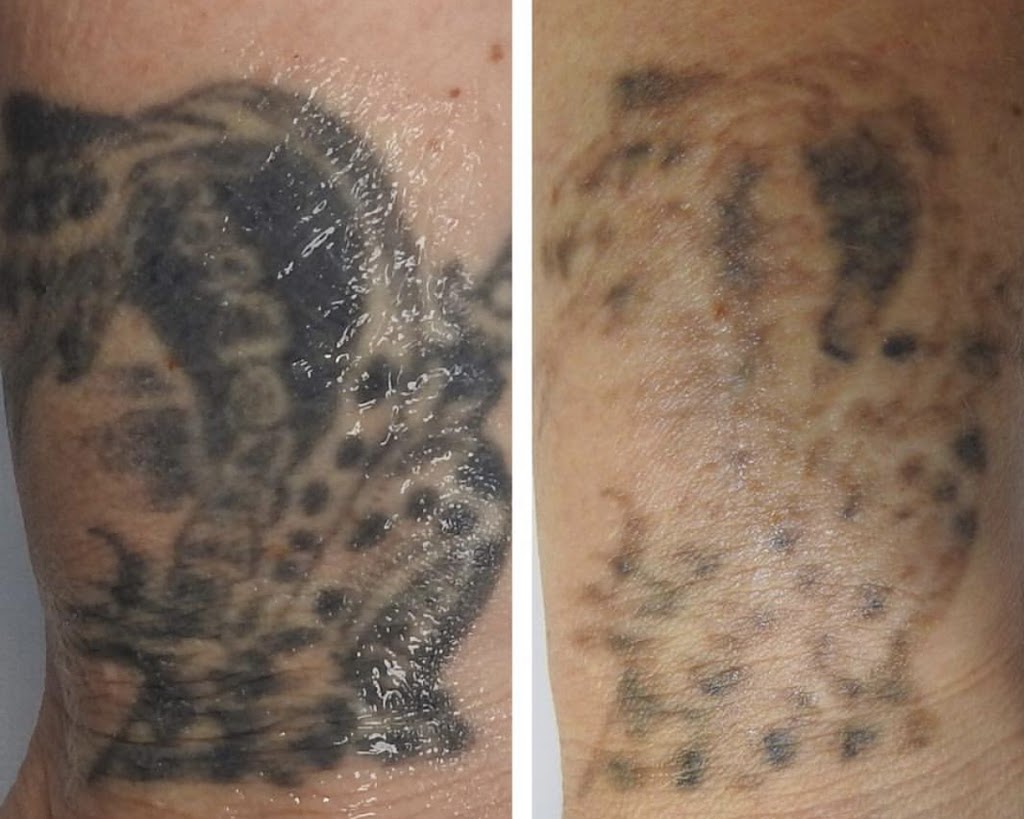 Precision Laser Therapy - Tattoo Removal & IPL Skin Rejuvenation | 56 Smith St, Summer Hill NSW 2130, Australia | Phone: (02) 9518 0735