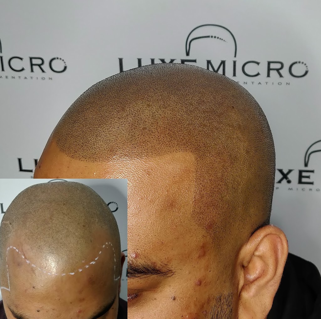 Luxe Micro, Scalp Micropigmentation Melbourne | hair care | 14 Ellaroo Circuit, Clyde North VIC 3978, Australia | 0451273940 OR +61 451 273 940