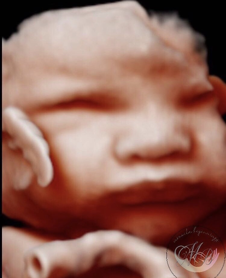 Miracle Beginnings 3D 4D Ultrasound | health | 17 Pyrus Pl, Redland Bay QLD 4165, Australia | 0412679932 OR +61 412 679 932