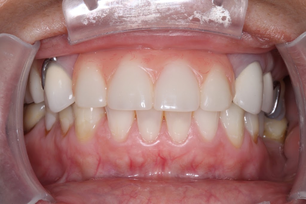Mark Hanson Denture Professionals | dentist | 3/235 Rockingham Rd, Spearwood WA 6163, Australia | 0894185788 OR +61 8 9418 5788
