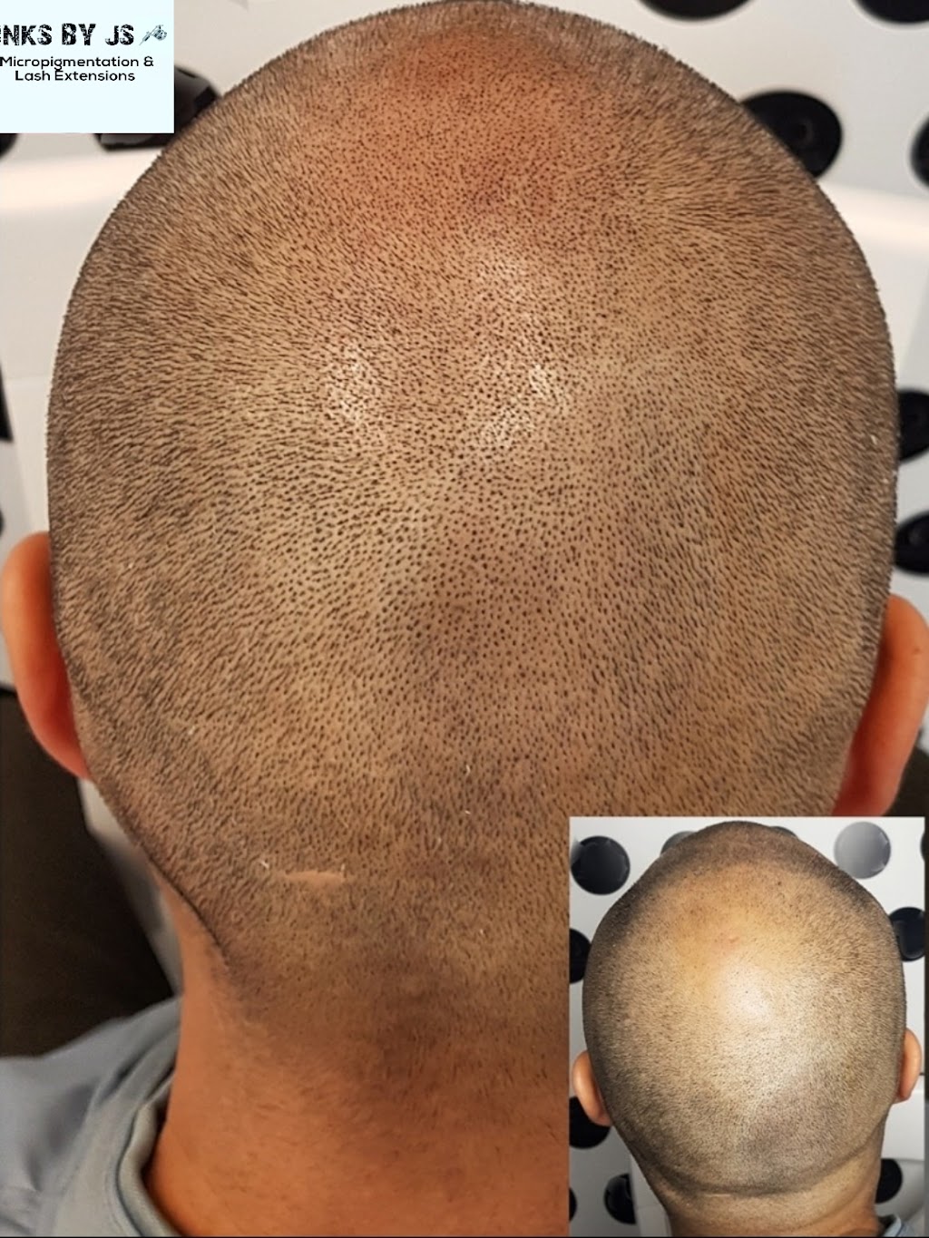 Scalp Micropigmentation SMP Melbourne Inks by JS | hair care | Sayers Rd, Tarneit VIC 3029, Australia | 0421844551 OR +61 421 844 551