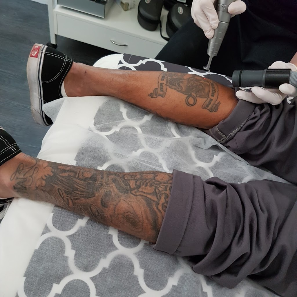 Back to Blank Laser Tattoo Removal | health | 12/130 Carillon Ave, Newtown NSW 2042, Australia | 0413349810 OR +61 413 349 810