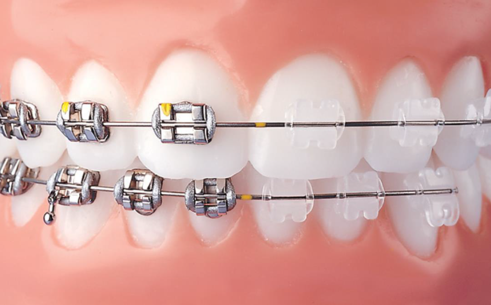 Inline Orthodontics | 12/2 Finucane Rd, Capalaba QLD 4157, Australia | Phone: (07) 3488 0002