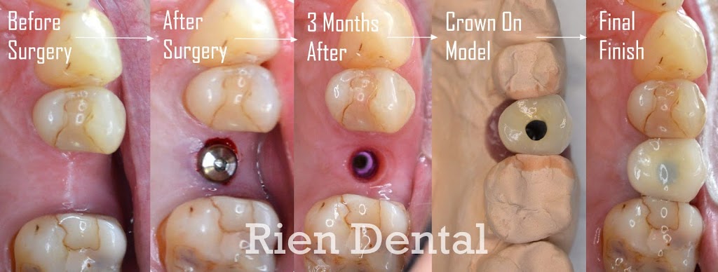 Rien Dental | dentist | 30 Balcombe Rd, Mentone VIC 3194, Australia | 0395831654 OR +61 3 9583 1654