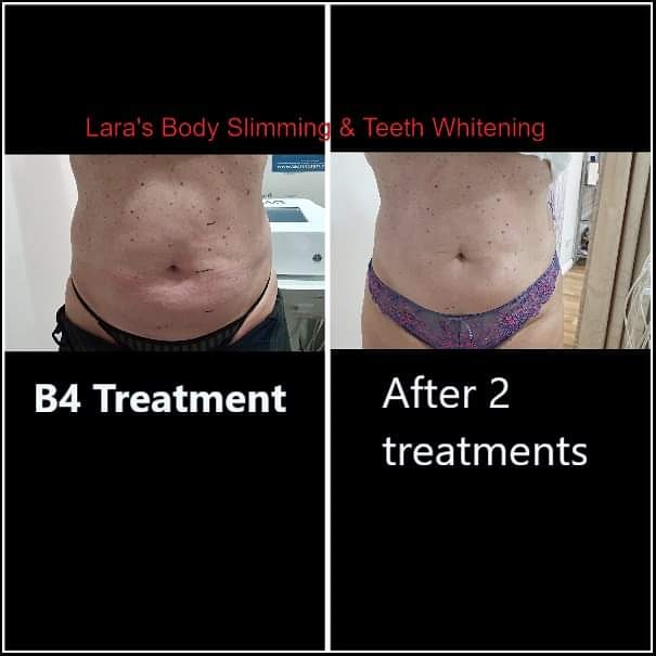 Laras Body Slimming & Teeth Whitening | 15 Fourteenth St, Warragamba NSW 2752, Australia | Phone: 0434 643 339