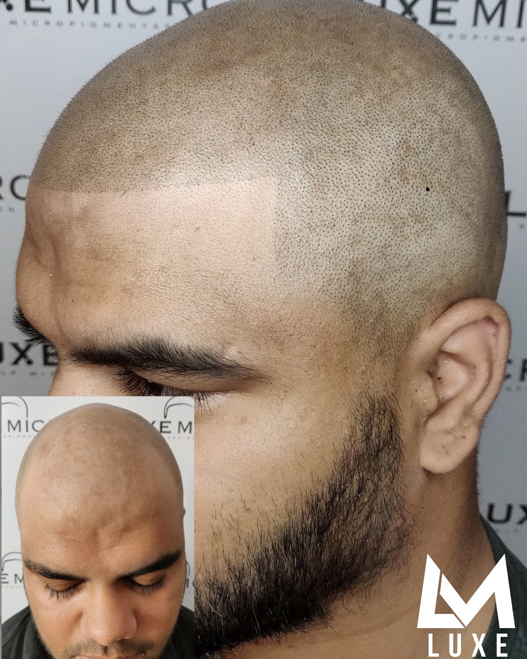 Luxe Micro, Scalp Micropigmentation Melbourne | 14 Ellaroo Circuit, Clyde North VIC 3978, Australia | Phone: 0451 273 940