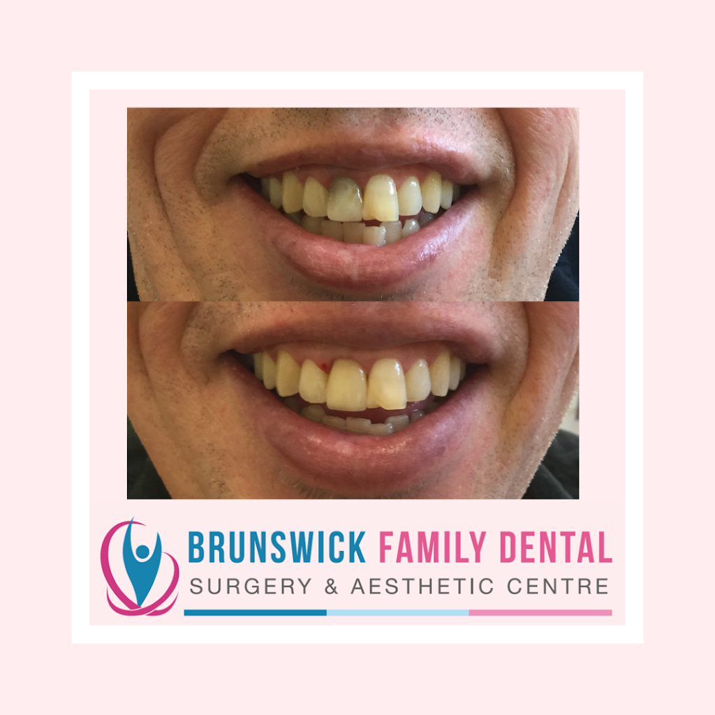 Brunswick Family Dental Surgery and Aesthetic Centre | dentist | 44 De Carle St, Brunswick VIC 3056, Australia | 0393867225 OR +61 3 9386 7225