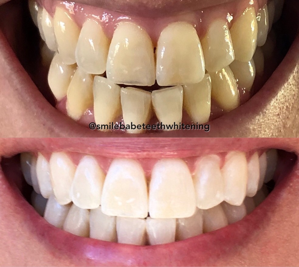 Smile Babe Teeth Whitening | dentist | 68 Cathedral Rocks Ave, Kiama Downs NSW 2533, Australia | 0423043736 OR +61 423 043 736