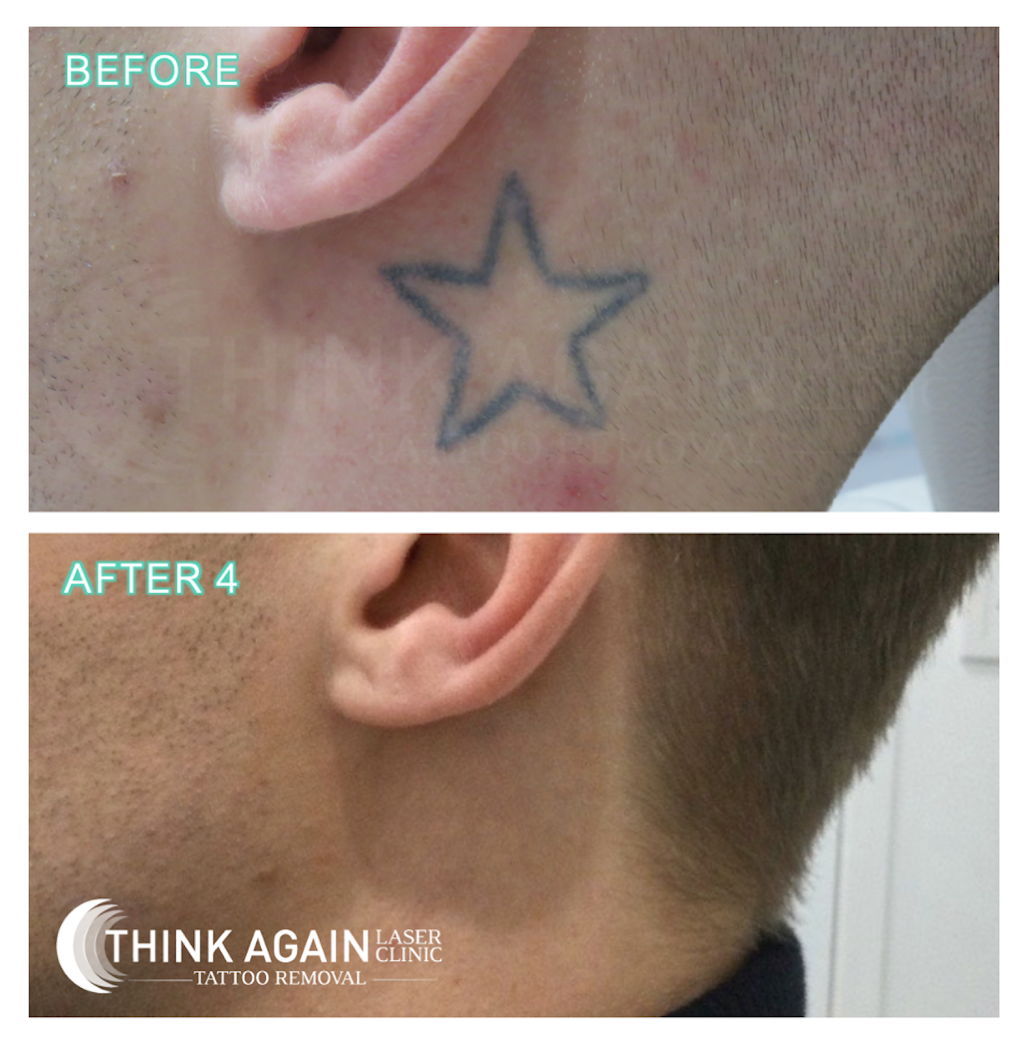 Think Again Laser Clinic | 2/188-190 Victoria Rd, Rozelle NSW 2039, Australia | Phone: 1300 166 465