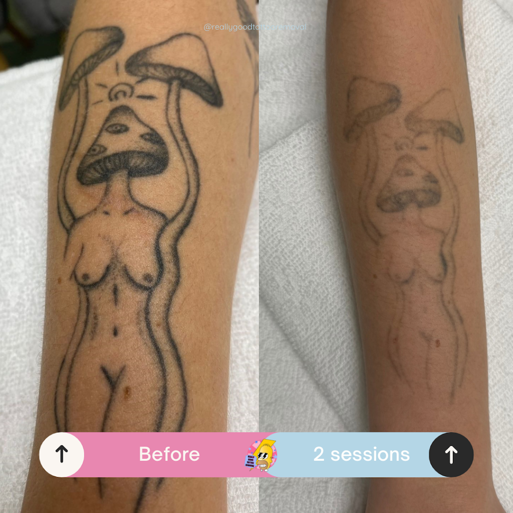 Really Good Tattoo Removal | 47 Clayton St, Sandgate QLD 4017, Australia | Phone: 0413 006 477