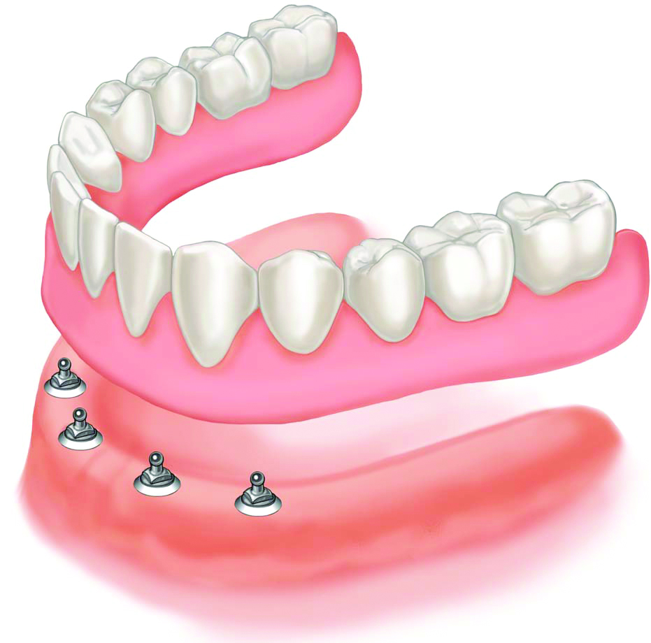 Bon Dent Denture Clinic | health | 41 Taylors Rd, St Albans VIC 3021, Australia | 0393669779 OR +61 3 9366 9779