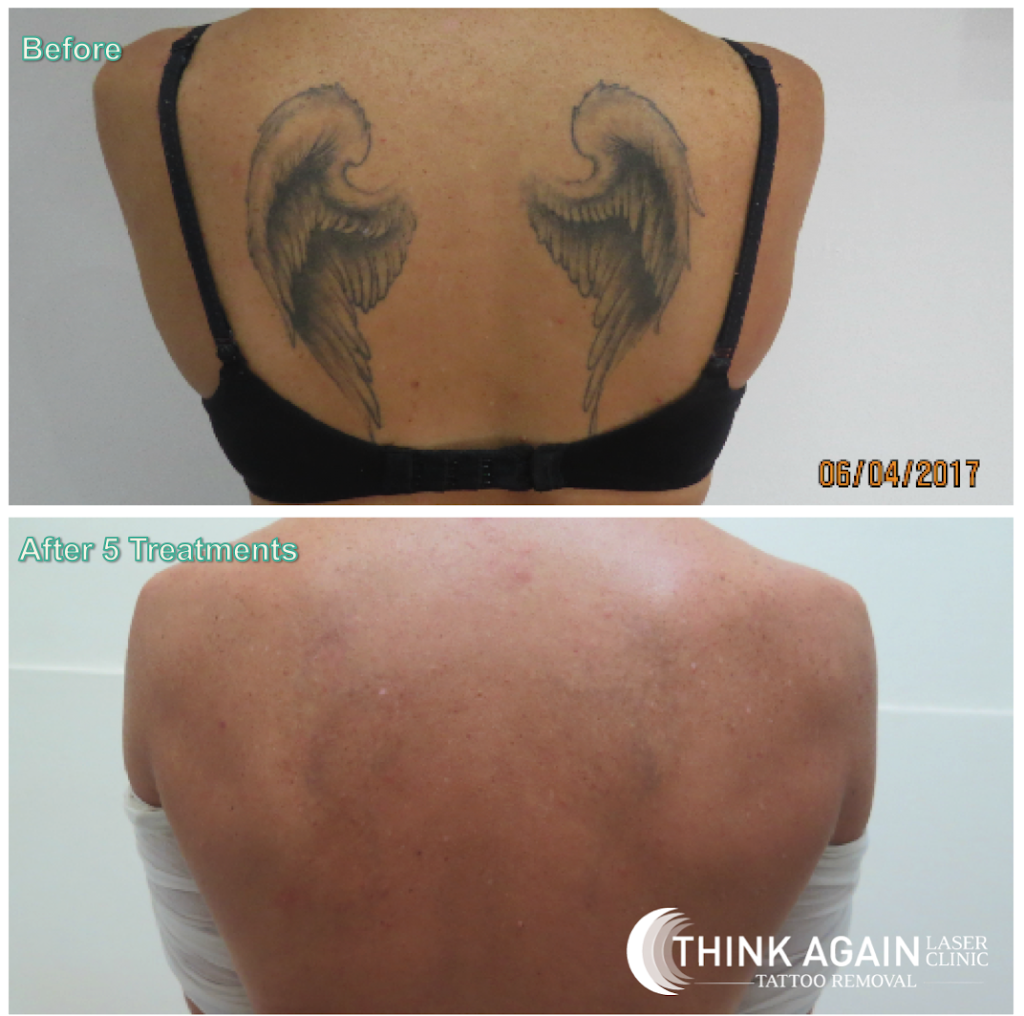 Think Again Laser Clinic | 2/188-190 Victoria Rd, Rozelle NSW 2039, Australia | Phone: 1300 166 465