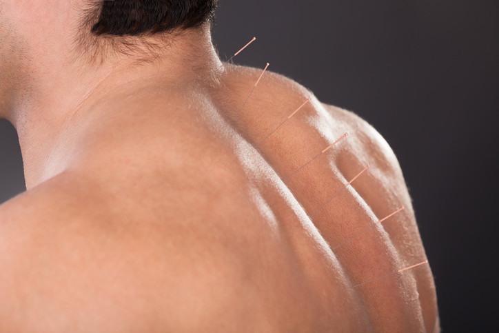 Mansfield Sports Acupuncture | 205 Piries-Goughs Bay Rd., (Piries), Mansfield VIC 3722, Australia | Phone: 0438 815 167