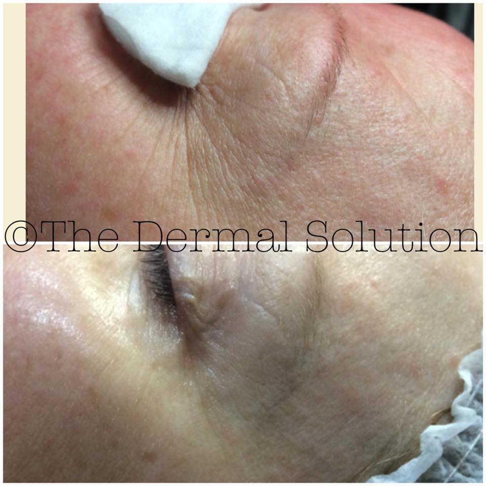 Dermal Solution Skin & Beauty Clinic | 279 Napier St, Strathmore VIC 3041, Australia | Phone: (03) 9379 8585