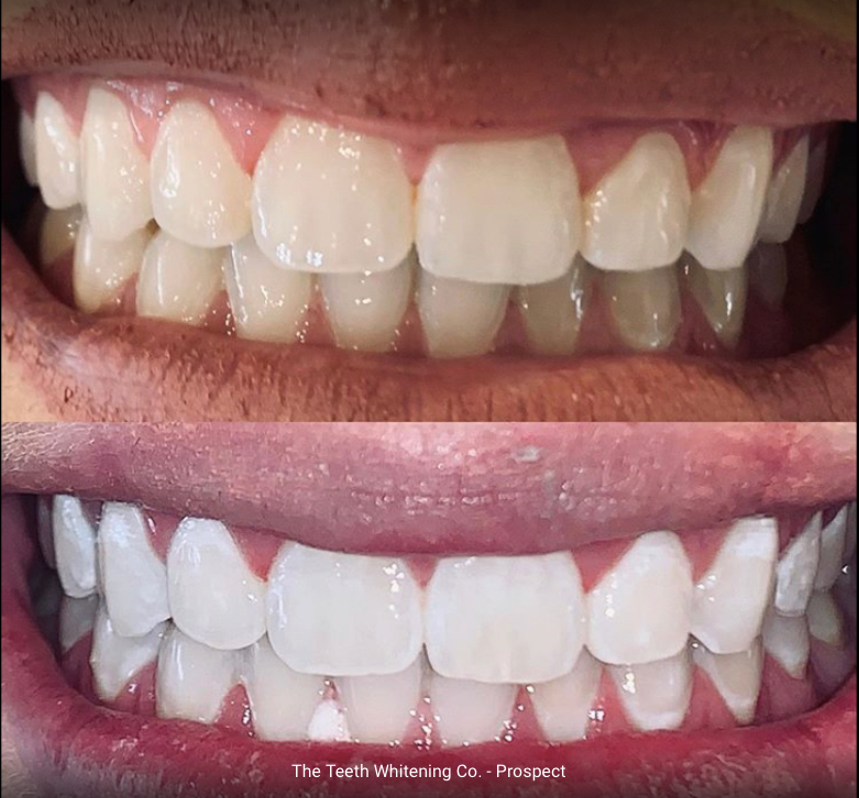 The Teeth Whitenin Co - Glenelg | 34 Ulinga St, Glenelg North SA 5045, Australia | Phone: 0401 047 857