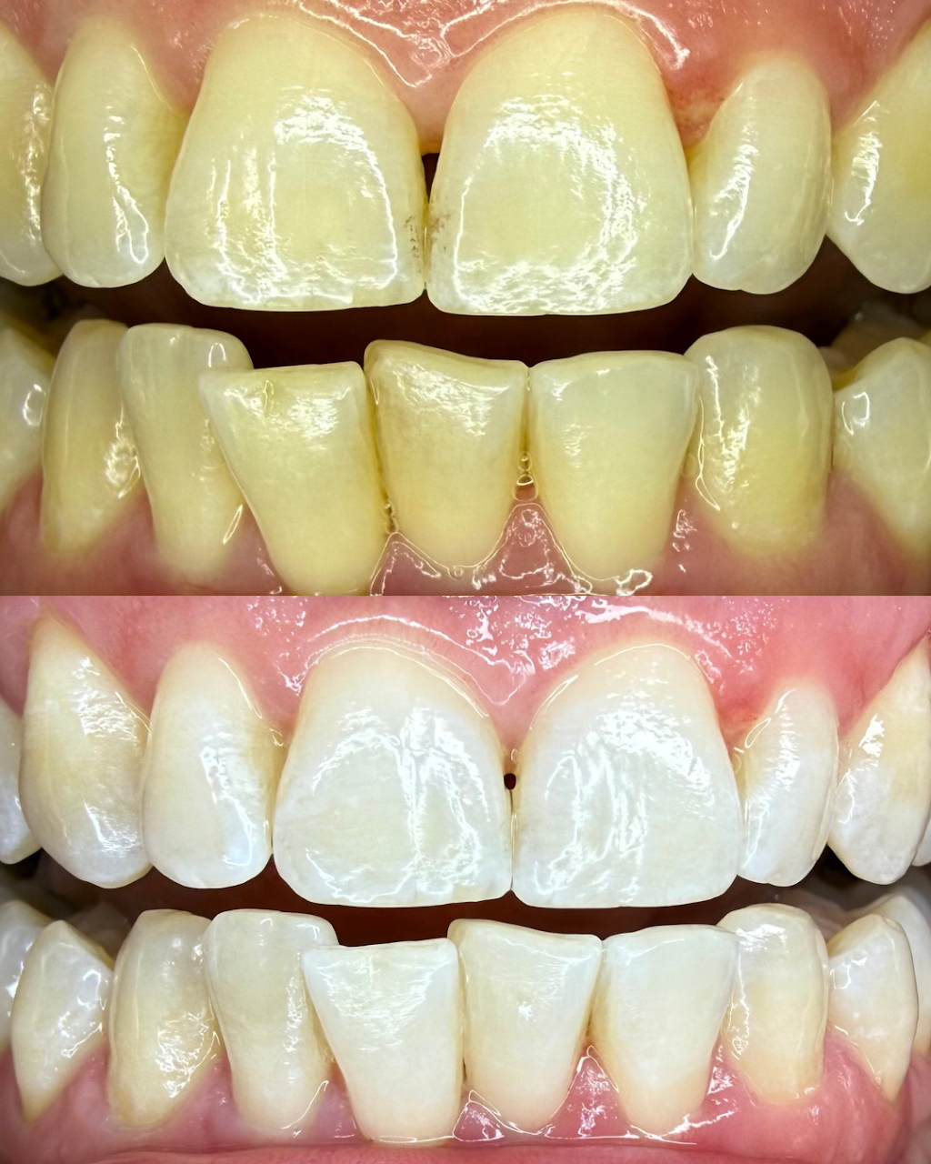 Purely Bright – Teeth Whitening & Brazilian Specialist | 108 Tanner St, Breakwater VIC 3219, Australia | Phone: 0432 037 011