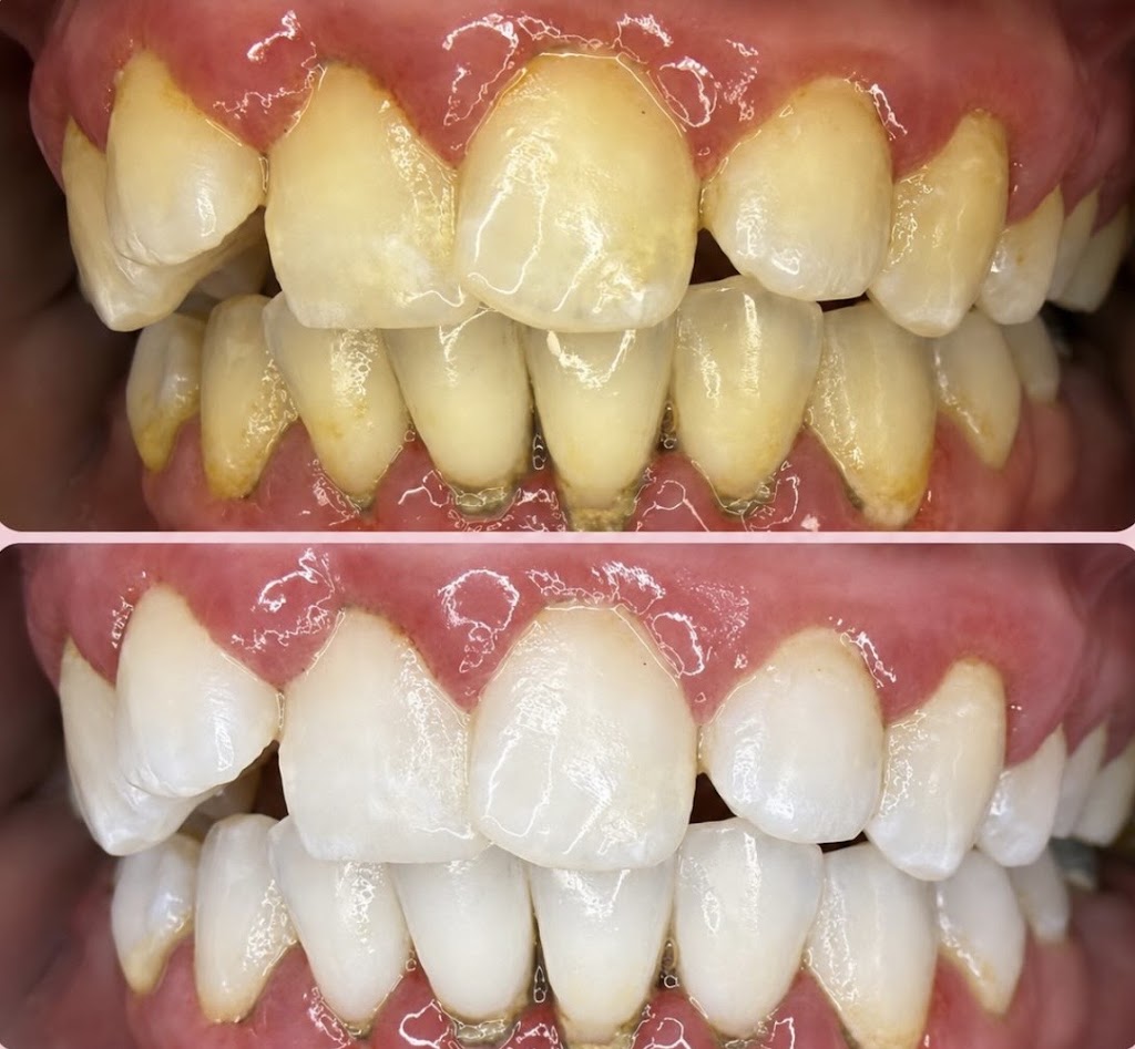 Purely Bright – Teeth Whitening & Brazilian Specialist | 108 Tanner St, Breakwater VIC 3219, Australia | Phone: 0432 037 011
