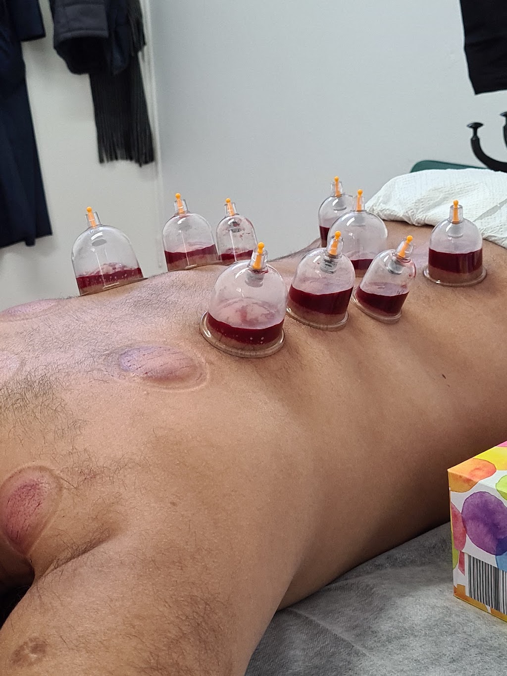 Cupping As-Sunnah | 12/58 Taylor St, Lakemba NSW 2195, Australia | Phone: 0423 948 856