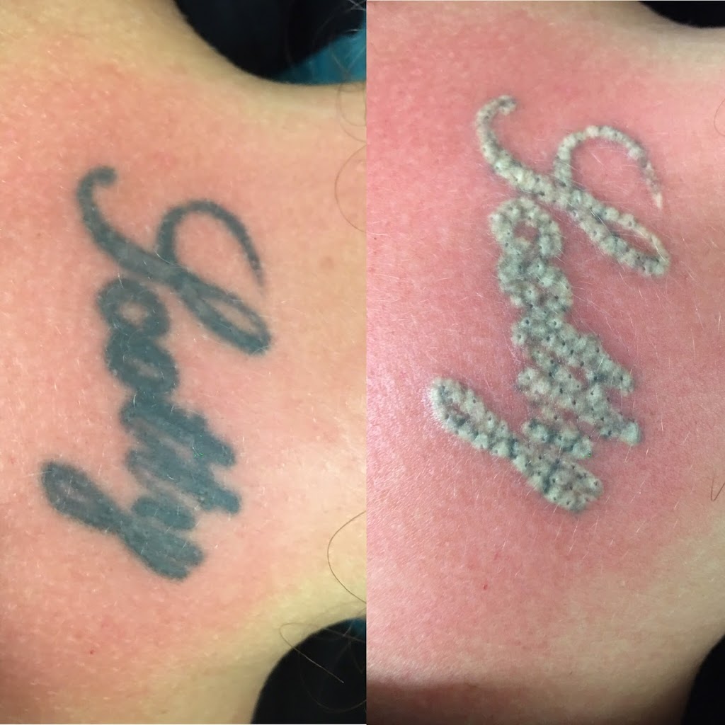 Gold Coast Tattoo Removal | 59 Church St, Boonah QLD 4310, Australia | Phone: 0402 450 901